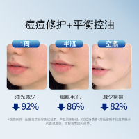 160g 祛痘爽肤水男女抗痘补水保湿化妆水控油收缩毛孔克星柔肤水