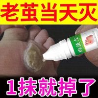 [体验装1只] 绿色JJY-庆飞堂 去脚死皮老茧脚底去除手上老茧硬皮脚茧软化剂脚趾头关节茧子神器