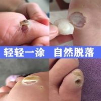 鸡疣液 鸡眼膏鸡眼贴去脚底脚趾死皮手足跖疣肉刺甲周疣老茧脚茧脚垫