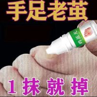 [体验装1只] 绿色JJY-庆飞堂 去脚死皮老茧脚底去除手上老茧硬皮脚茧软化剂脚趾头关节茧子神器