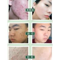 清洁面膜深层去黑头粉刺水杨酸清痘印收缩毛孔泥膜油皮痘痘嫩白女