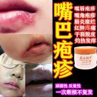 嘴巴嘴角嘴唇疱疹唇炎上火起水泡糜烂炎唇膏干裂起皮脱皮专用乳膏