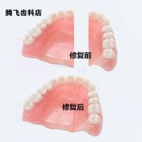 假牙胶水假牙粘合剂假牙断裂假牙脱落假牙加牙自己动手粘假牙 北京地区专拍