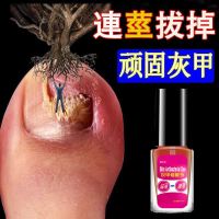 [灰甲克星]灰指甲专用液祛坏甲脆甲变色增厚萎缩特效修复液 1盒[试用 建议多盒]