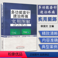 [正版]彩图 多功能套针速治疼痛实用图解 石学敏主审 侯国文主编 中国中医药出版新型浮针 皮下套管针灸临床研究社 新型