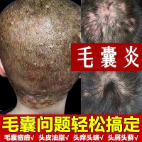 头皮去螨虫除螨护理头皮癣专用洗发水露洗脂溢性头皮炎去屑