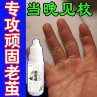 无痛去除手上关节脚指底老茧厚茧鸡眼死皮软化剂专用神器