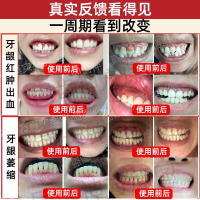 牙龈萎缩修复再生牙齿松动修复固齿牙缝宽大神器出血牙粉防蛀牙