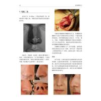 美容鼻整形术——鼻部多边形模型在鼻整形中的应用