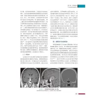 成人中枢神经系统肿瘤放射治疗学:从理论到实践