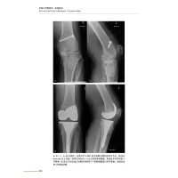 全膝关节翻修术:实用指南
