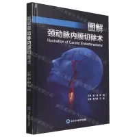 [N]图解颈动脉内膜切除术(精)-9787565927652