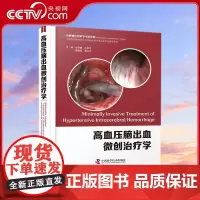 [央视网]高血压脑出血微创治疗学 从开颅手术到微创锁孔手术 从粗略定位到精确三维定位 从硬通道到软通道ZK