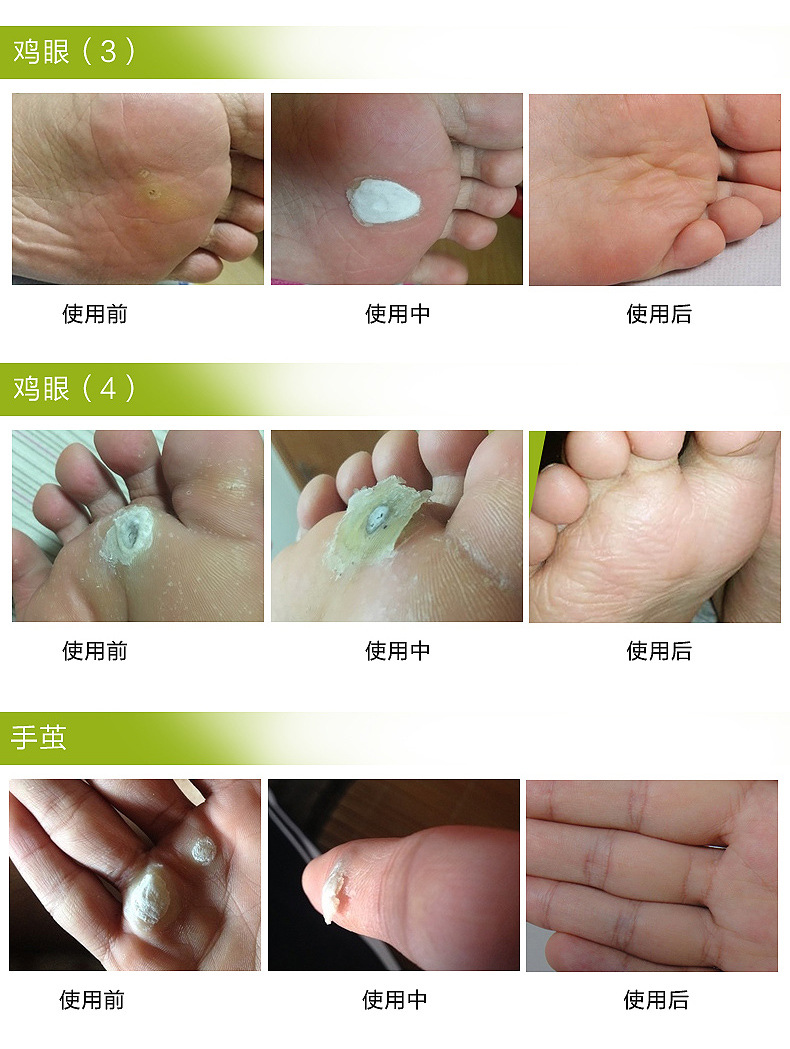 美目盼兮祛茧膏非何医生去鸡眼处理工具盒跖疣膏去