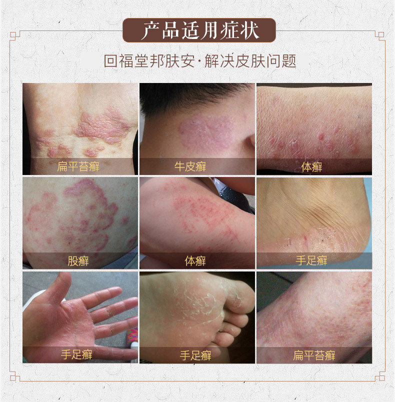 回福堂邦肤安20克止痒乳膏软膏过敏性皮炎皮肤瘙痒湿疹股癣体癣杀菌