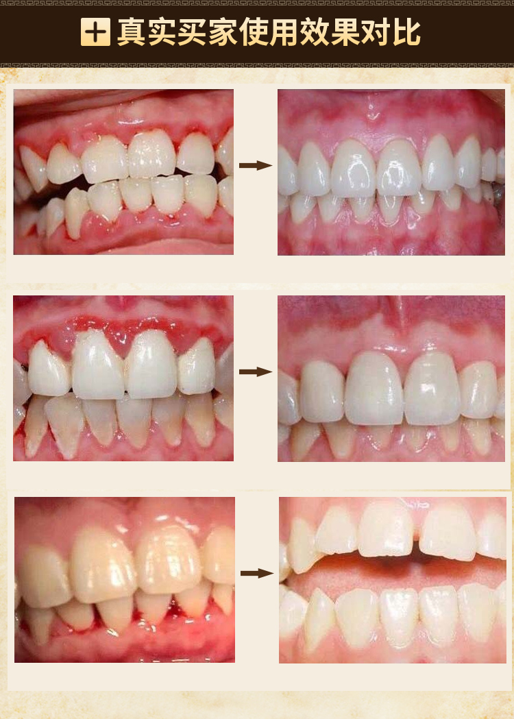 店长主推防蛀牙龈萎缩修复牙出血牙齿松动牙疼牙痛口臭牙粉旱莲固齿安