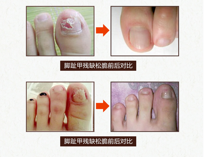 回福堂马甲修复素套装20ml(2支装)灰指甲套装灰甲抗菌液甲沟炎抑菌甲