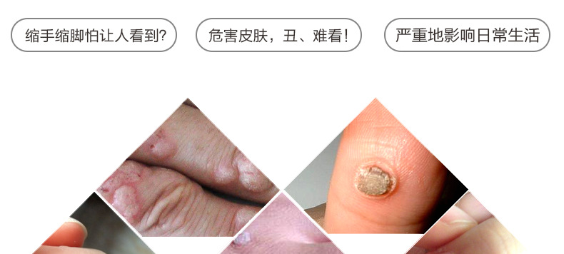 买2送1康纳牌滴优抗菌膜剂8ml特效瘊疣净祛去疣灵膏跖疣康血胞刺刺猴