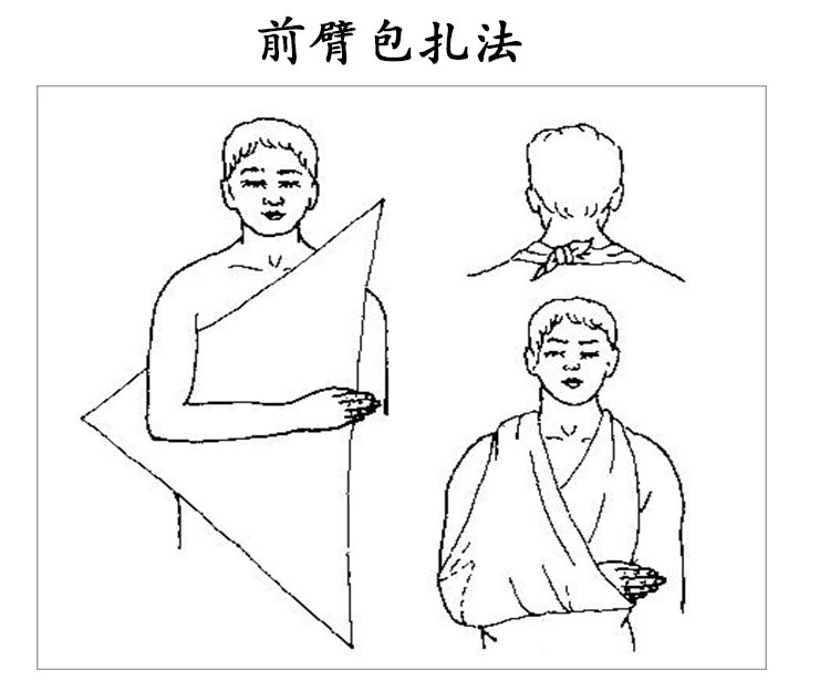 肩关节三角巾固定法图片